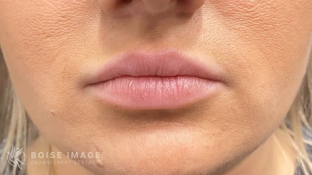 Lips Before