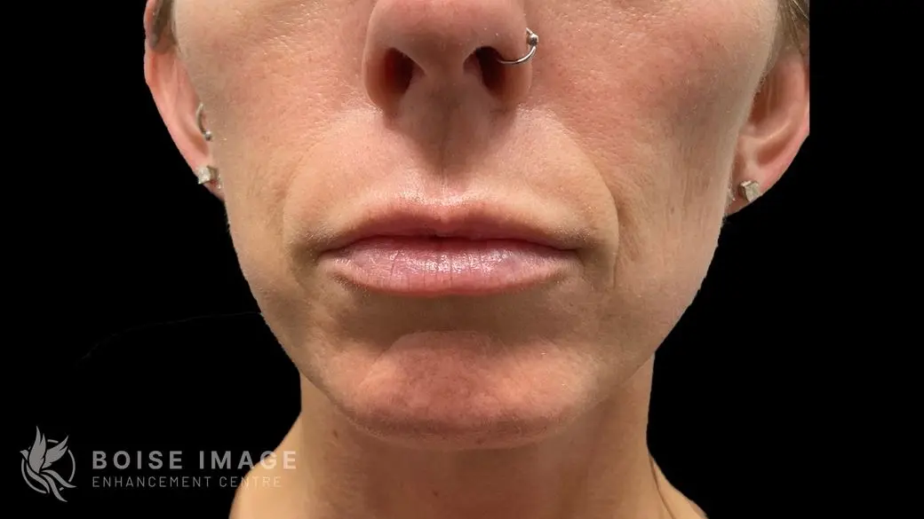 Lips After