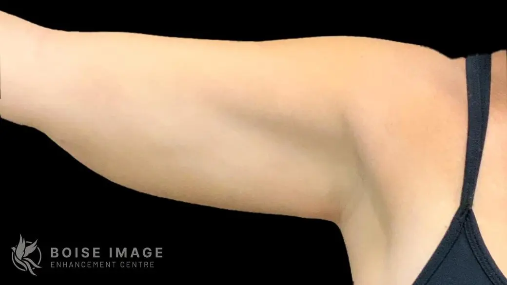 Right Arm After