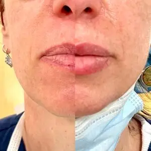 Lip Filler