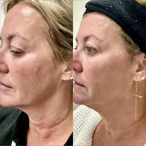 Light and Bright Laser Treatment