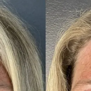 Botox
