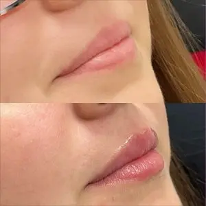Lip Filler
