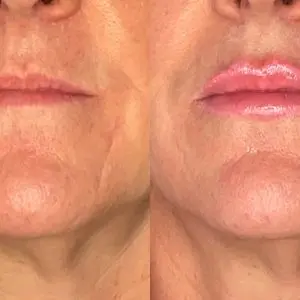 Lip Filler