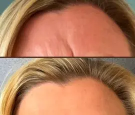 Botox