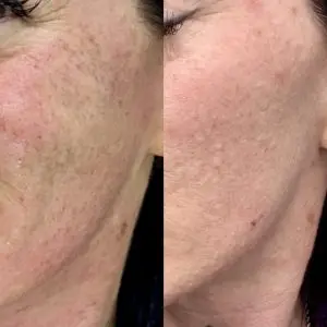 Light and Bright Laser Treatment
