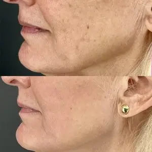 Light and Bright Laser Treatment