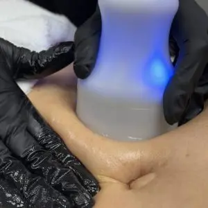 NeveSkin Skin Treatment