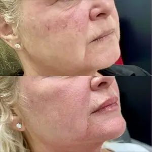 Lip Filler