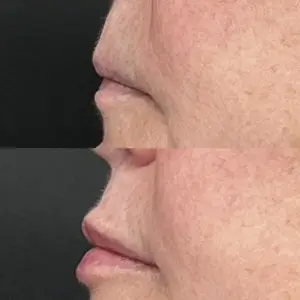 Lip Filler