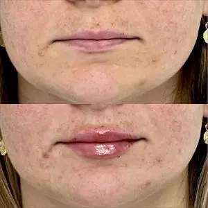 Lip Filler