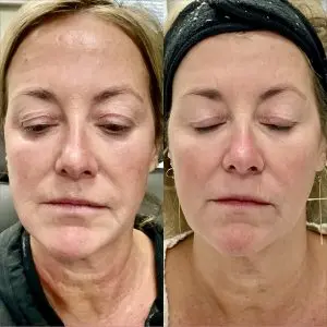 Light and Bright Laser Treatment