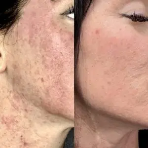 Light & Bright Laser Treatment