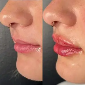 Lip Filler