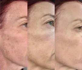 Laser Skin Treatment Progression