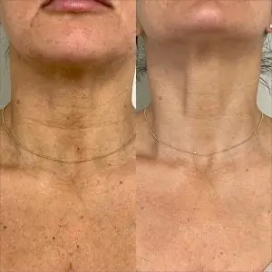 Light and Bright Laser Treatment