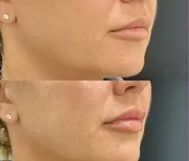Lip Filler
