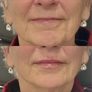 Lip Filler