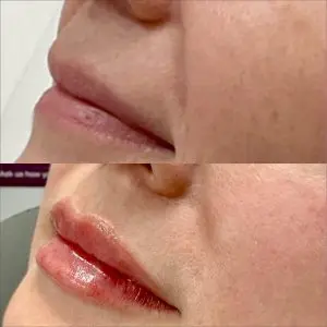 Lip Filler