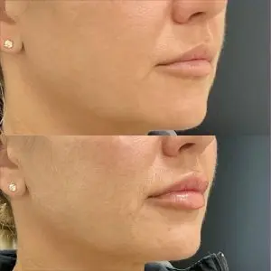 Lip Filler
