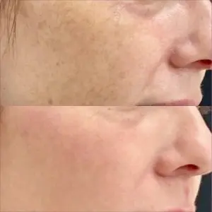 Light and Bright Laser Treatment