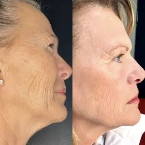 Laser Skin Treatment