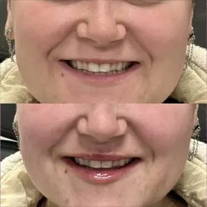 Lip Filler