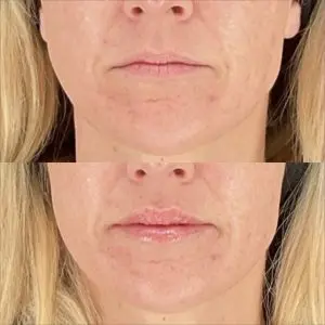 Lip Filler