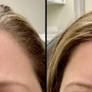 Botox