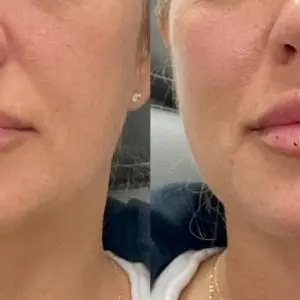 Dermal Filler