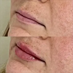 Lip Filler