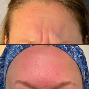 Botox