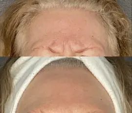 Botox