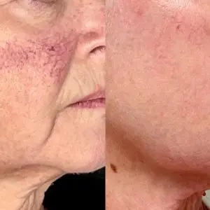 Light and Bright Laser Treatment