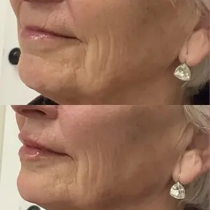 Lip Filler