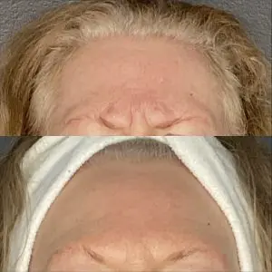 Botox
