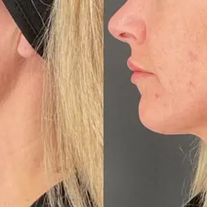 Lip Filler