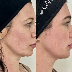 Light and Bright Laser Treatment