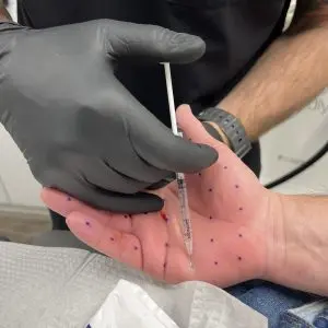 Botox for Sweaty Palms