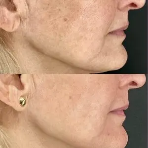 Light and Bright Laser Treatment
