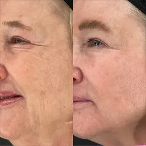 Light and Bright Laser Treatment