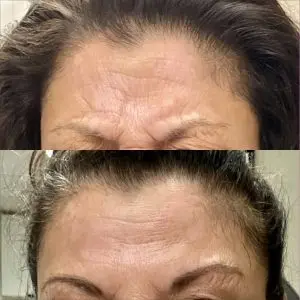 Botox