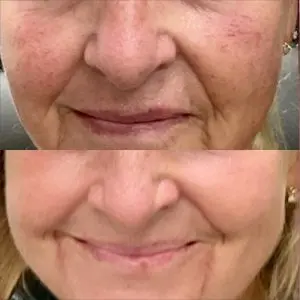 Light and Bright Laser Treatment