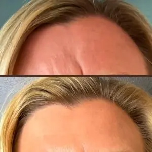 Botox