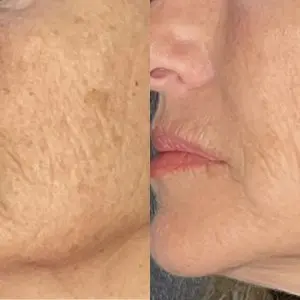 Light and Bright Laser Treatment