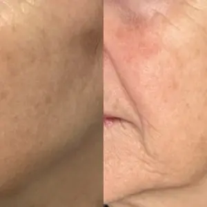 Light and Bright Laser Treatment