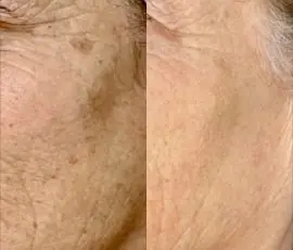 Laser Skin Treatment