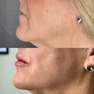 Lip Filler