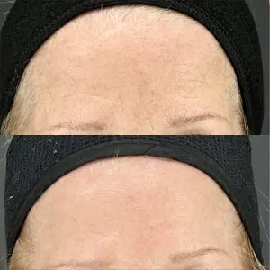 Light & Bright Laser Treatment