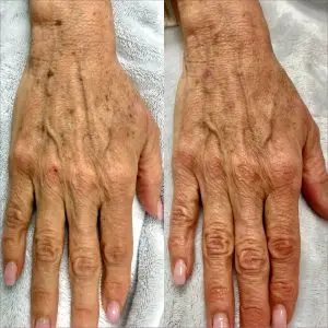 Light and Bright Laser Treatment